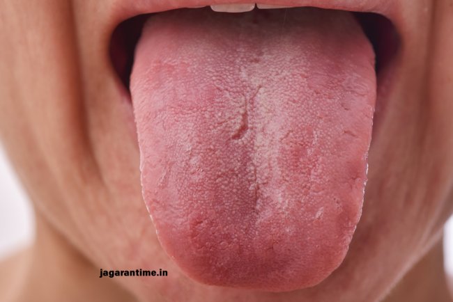 जुबान का रंग काला क्यों हो जाता है? जानिए कारण, लक्षण और घरेलू इलाज